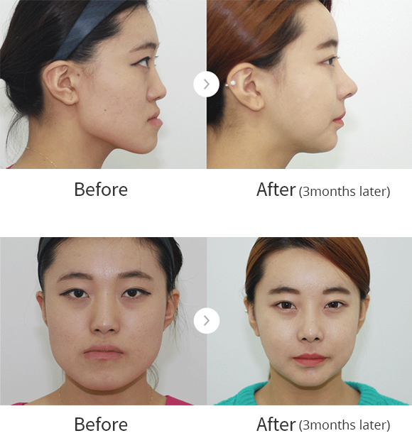 30+ Great Jaw Surgery Aesthetic Photos
